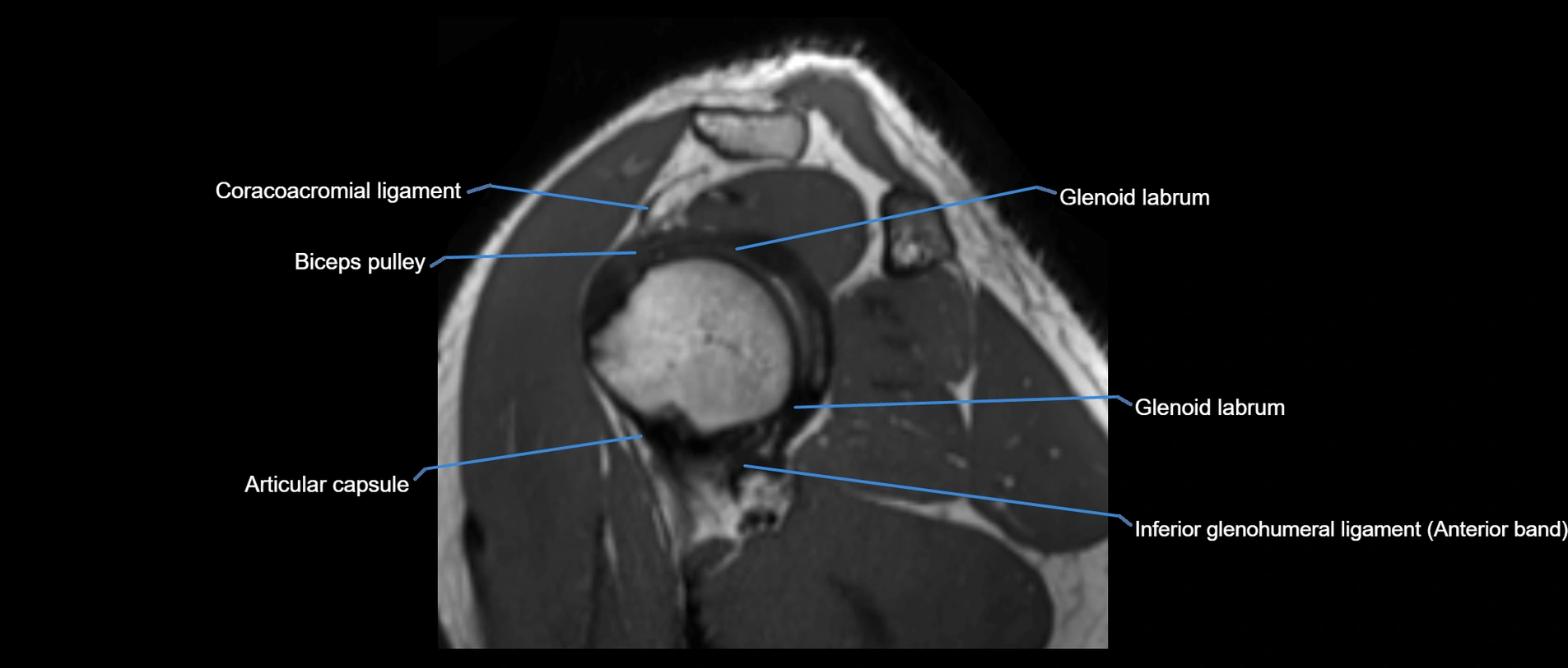 shoulder ligaments sagittal  cross sectional anatomy 3T MRI AI enhanced radiology image -img-00001-00031.webp